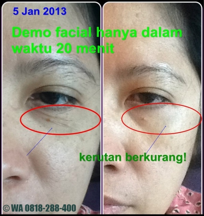 Kerutan Hilang Dalam 20 Menit dengan Luminesce